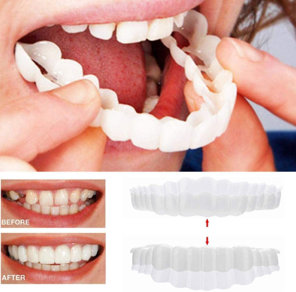 SMILELUX – Ensemble de Facettes Supérieures et Inférieures pour Améliorer l'Esthétique du Sourire