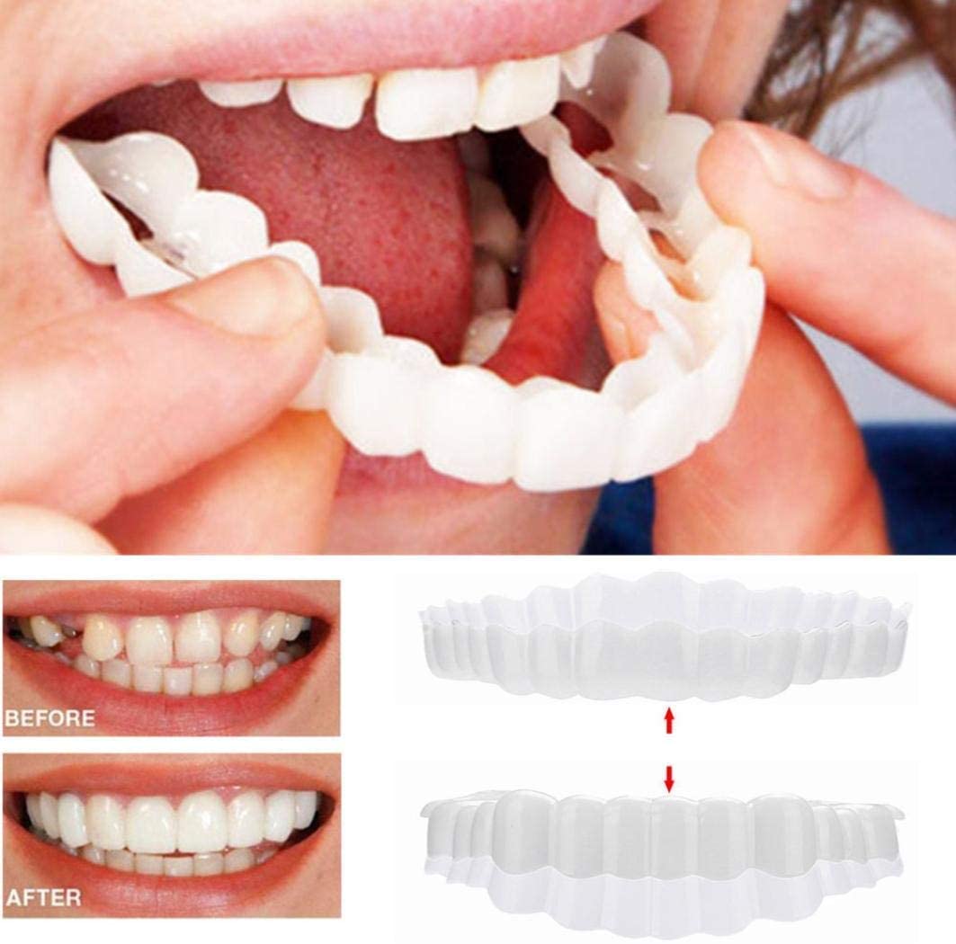 SMILELUX – Ensemble de Facettes Supérieures et Inférieures pour Améliorer l'Esthétique du Sourire