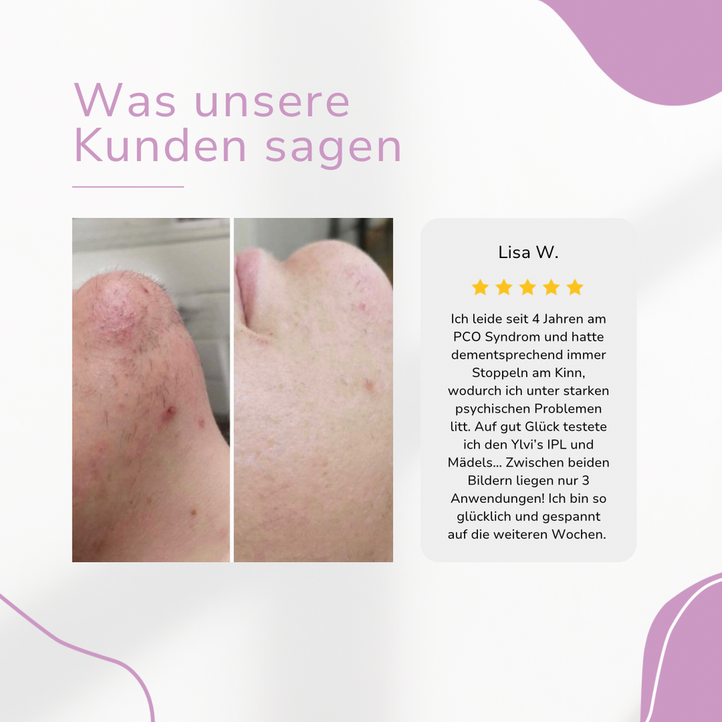Venzani Ylvis IPL Épilateur I La meilleure épilation laser à domicile