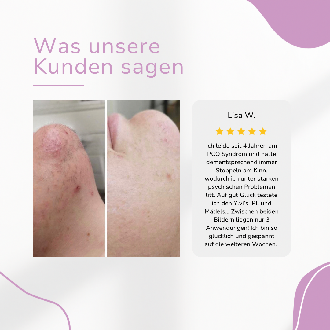 Venzani Ylvis IPL Épilateur I La meilleure épilation laser à domicile