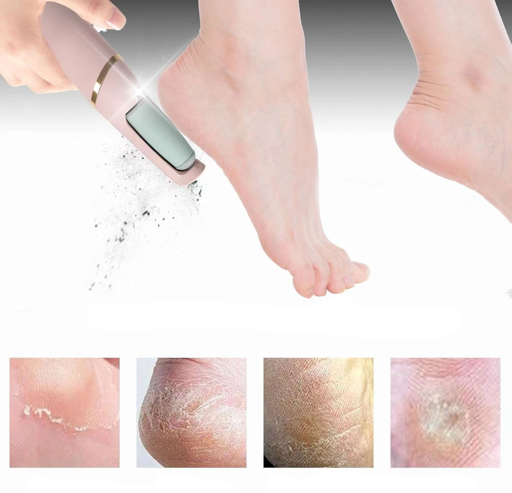 Épilateur de callosités pour les pieds – Pour des pieds doux et soignés
