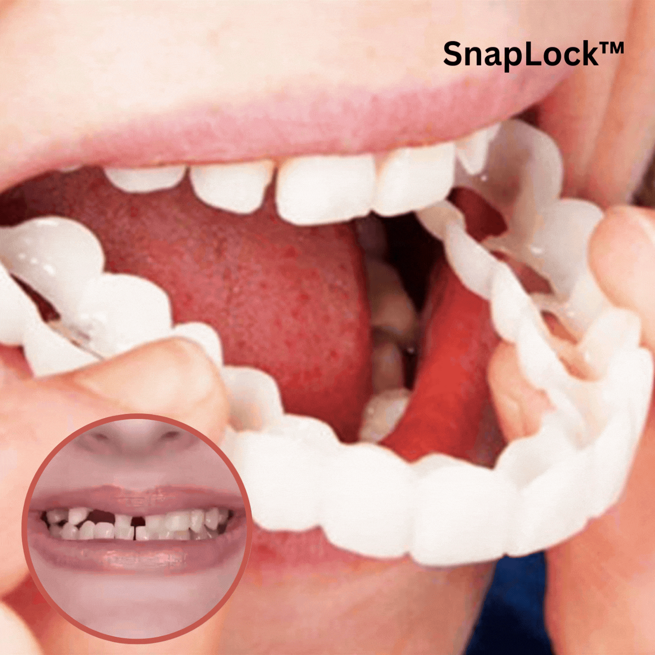 1+1 Gratuit | SnapLock™ | Prothèse dentaire à clipser