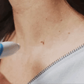 TagGone Kit de Retrait Auto-Tag | Application sans douleur | Pour une peau lisse et uniforme