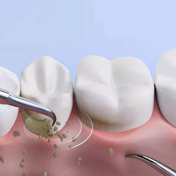 Détartrage Dentaire Ultrasonique pour l'Hygiène Bucco-Dentaire