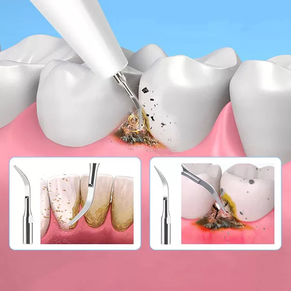 Détartrage Dentaire Ultrasonique pour l'Hygiène Bucco-Dentaire